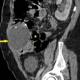 Contrast-enhanced abdominal CT in sagittal (Figure 1a) and axial reconstructions (Figure 1b) showing an anterior abdominopelvic large cystic lesion (Figure 1a, yellow arrow) well defined, with a thin non-enhanced wall, and the tip of the ventriculo-peritoneal shunt ending within the lesion (Figure 1b, yellow arrowhead) with posterior mass effect on the bowel loops (Figure 1a, yellow star)