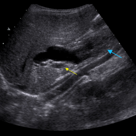 Axial ultrasound image of the hepatic hilum region demonstrating intra and extrahepatic biliary dilatation. There is a lesion