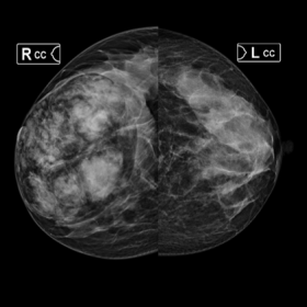 Cranio-caudal images of both breasts with right breast showing  a large well defined encapsulated oval mixed density mass lesi