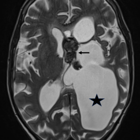 Axial T2W image - a lobulated T2 hypointense lesion (black arrows) along anterior septum pellucidum. Left lateral ventricle is dilated and shows intraventricular adhesions (black asterisks) and trapping left of frontal horn