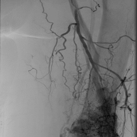Digital Subtraction Angiography demonstrated multiple pathological branches from the left profunda femoral artery