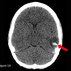 In the axial view of the non-enhanced CT brain image, the red arrow indicates an acute intraparenchymal hematoma in the left parietal lobe, with oedema surrounding the bleeding area.