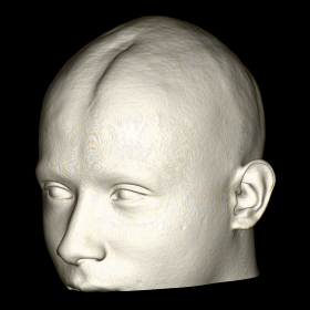 3D reconstruction that shows the atrophic skin lesion in the right frontoparietal region.