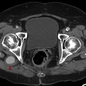 Axial contrast-enhanced CT image in portal venous phase shows a dilated vascular structure with peripheral thrombus (arrow).