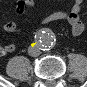 Axial pre-contrast CTA image showing the presence of a thin hyperdense layer (arrowhead) situated outside the metallic endosk
