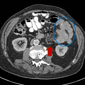 Axial contrast-enhanced CT showing medialisation of the descending colon (red arrow), and small bowel loops (blue circle) occ