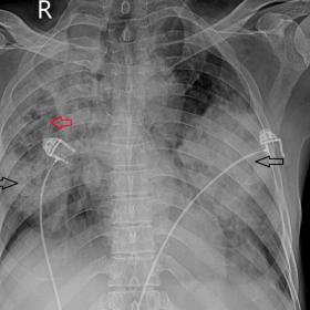 Chest X-ray PA view showing bilateral lung consolidation (black arrows) with multiple cystic lucencies seen in the right mid zone (red arrow).