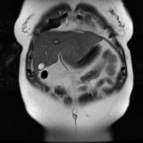 Coronal T2 MRI showing 4th segment liver lesion with a hypointense rim and a hyperintense central signal.