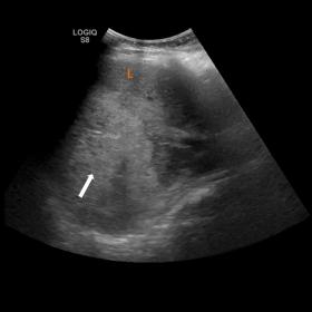 The ultrasound revealed a large and well-defined hyperechoic lesion on the right liver lobe (arrow). (L) normal liver parenchyma.