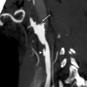 Sagittal maximum-intensity projection of computed tomography angiography showing a saccular aneurysm of the common carotid artery (arrowhead), which shows a diffusely irregular calibre. Note also the complete occlusion of the ipsilateral internal carotid artery (arrow).