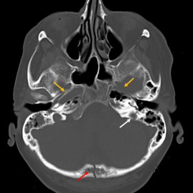 Axial CT head in bone window shows a fracture of the occipital bone (red arrow) and a second fracture extending through the l