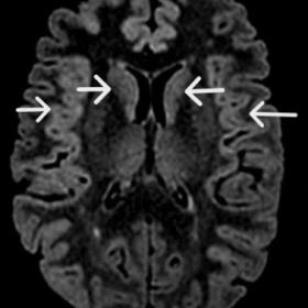 Plain MRI Brain, FLAIR axial (1a) and T2WI axial (1b) show symmetrical gyriform hyperintensities involving predominantly bila