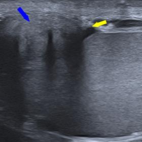 Transverse greyscale US image of the left hemiscrotum. Left paratesticular mass (blue arrow) measuring 34 x 15 x 17 mm dependent on the tunica albuginea (yellow arrow). The lesion is slightly heterogeneous, mainly hypoechoic, compared to the adjacent normal testis.