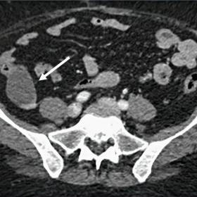 Axial CT portal phase identifying a well-defined 30mm cystic mass in the right iliac fossa separate from the bowel (arrow).