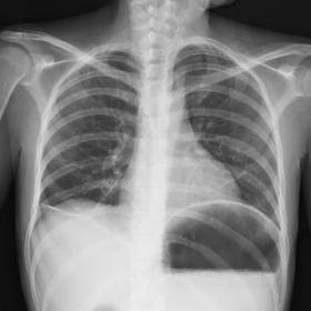 A chest (PA) X-ray showed a marked gastric distention and the presence of gas-fluid levels at the duodenal level, and an atelectasis in the right lower lobe.