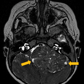 Axial T2 with heterogeneous signal and multiple cystic foci (arrows).