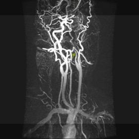 Contrast-enhanced MRA (coronal MIP images) of neck vessels showing narrowing of the internal carotid artery with distal occlu