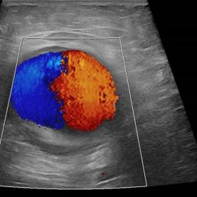 Transverse ultrasound image of the right groin with colour Doppler view demonstrating the characteristic “yin-yang” patte