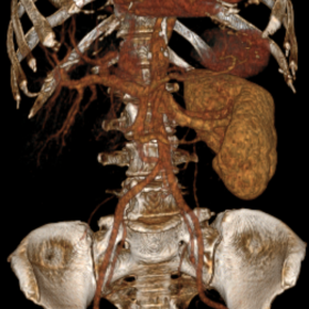 3D reconstruction of the abdomen shows no right kidney and its vasculature.