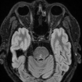 FLAIR (1a), DWI (1b) and ADC (1c) sequences of MRI displaying an area of restricted diffusion within the right pons, associated with medial longitudinal fasciculus (MLF) ischaemia.