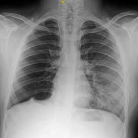 Chest radiograph PA view showing unilateral (right) hyperlucent hemithorax with paucity of vessels/oligemia and mild bronchiectasis in the right lower zone. The right hilum appears relatively smaller sized. Pleural tenting in the right lower zone. Bilateral costophrenic angles are blunt. No mediastinal shift.