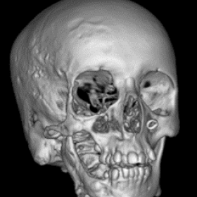 Computed tomography of the face: 2a, non-contrast axial; 2b, arterial phase axial; 2c, venous phase axial; 2d, bone window axial; 2e, bone window coronal; 2f, three-dimensional reconstruction produced with Volume Rendering; showing soft tissue thickening in the subcutaneous tissue of the right half of the face, hypertrophy of the parotid gland, and osteolytic processes affecting the right hemimandible, maxillary alveolus, zygoma, greater wing of the sphenoid, and pterygoid body and plates.