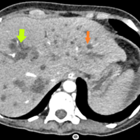 Axial contrast-enhanced CT abdomen showing multiple cholangitis abscesses (green arrow) and dilated intrahepatic bile ducts (orange arrow).