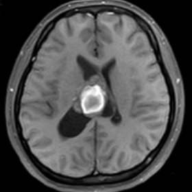 Axial T1 fat saturation pre-contrast showed intraventricular tumour mass with (subacute haemorrhage) high signal intensity in