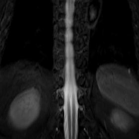 Axial T2WI and coronal STIR images show split cord malformation (Diastematomyelia).