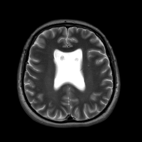 Axial T2W MRI image shows absence of septum pellucidum.
