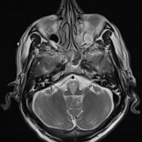 Axial T2 weighted, FLAIR MRI image of the brain at the level of the medulla, showing high signal changes in the medial medulla bilaterally.