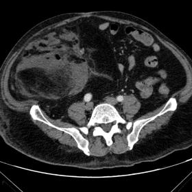 Abdominal axial CT scan, with venous phase contrast: the extraperitoneal fatty components cause displacement to the left, suggesting inflammation.