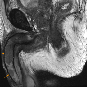 MRI study exhibiting multiple metastatic penile lesions: Sagittal T2-weighted image showing several intermediate signal intensity penile lesions.