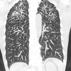 Coronal CT with multiplanar reconstruction (10mm thickness) showing numerous well-defined lung nodules with an apical and per