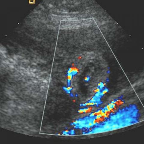 Ultrasound In Ectopic Pregnancy