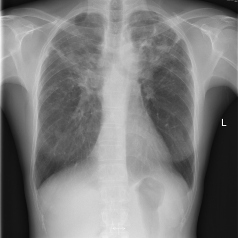 Pleural thickening in a patient with known sarcoidosis | Eurorad
