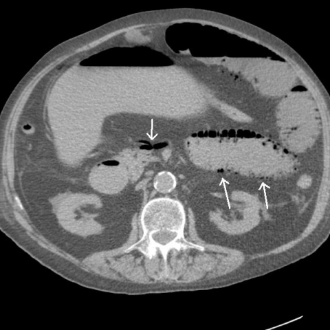 Acute small bowel ischaemia and infarction | Eurorad