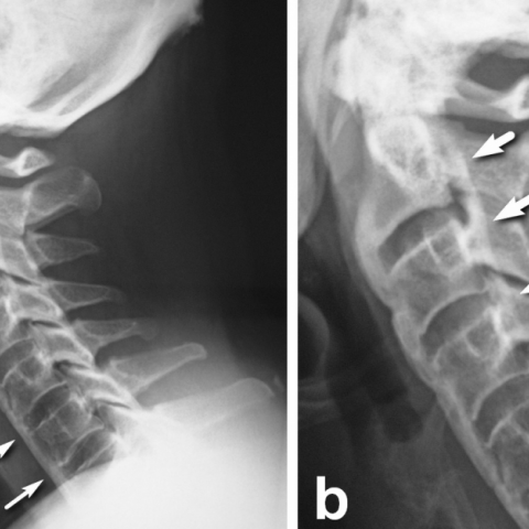 DISH and OPLL of the cervical spine | Eurorad