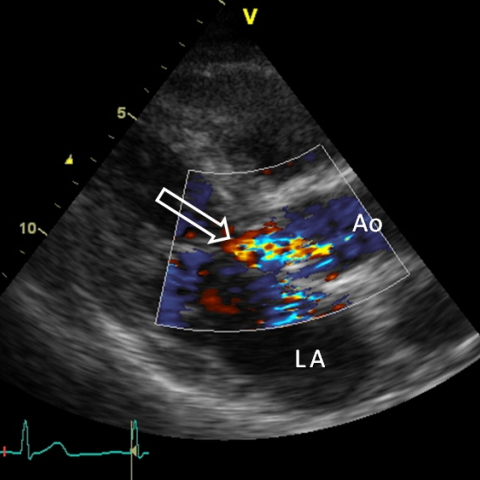 Cardiac CT in native valve endocarditis | Eurorad