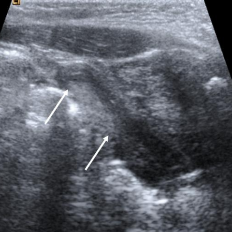 RadioGraphics on X: A groin lump is not uncommon in girls and female  infants. Are you familiar with the US anatomy of the female inguinal canal?  This article reviews US technique and