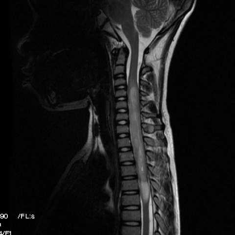 Spinal cord astrocytoma | Eurorad