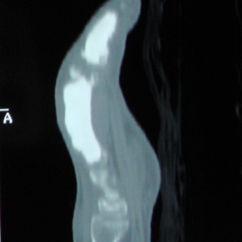 Dripping candle wax sign (melorheostosis), Radiology Reference Article