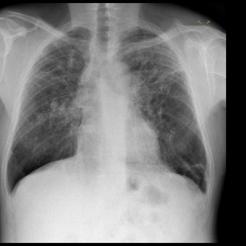 Paraquat induced pulmonary fibrosis | Eurorad
