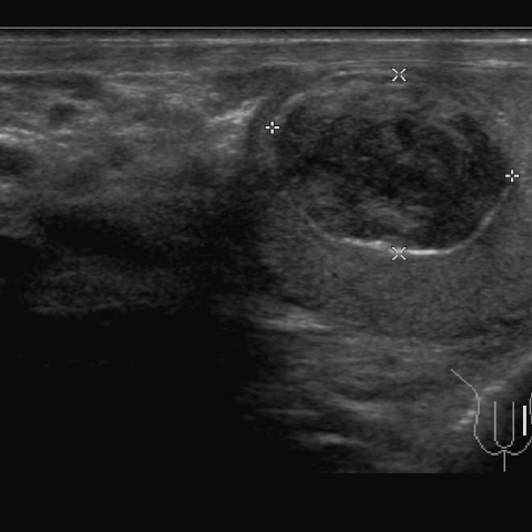 Epidermoid cyst - left testicular benign mass | Eurorad