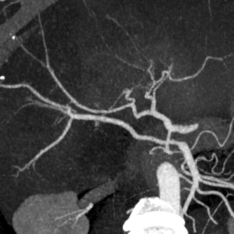 CT angiography and biliography
