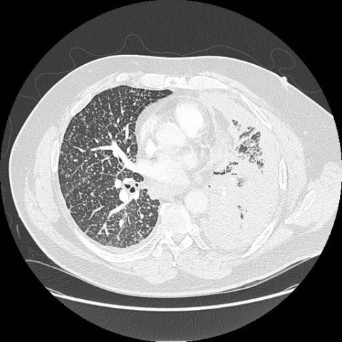 is atypical mesothelial hyperplasia cancer