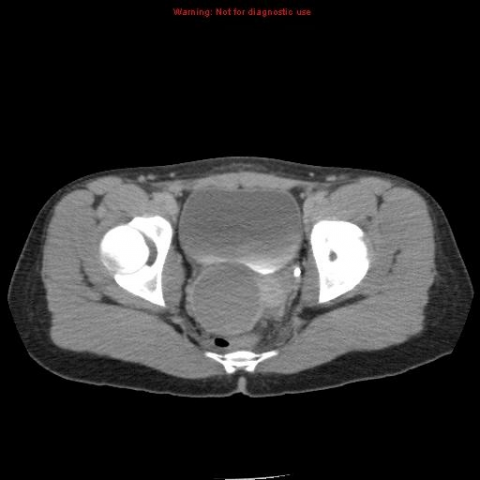 Teenage Female Patient With Right Lower Quadrant Pain Eurorad