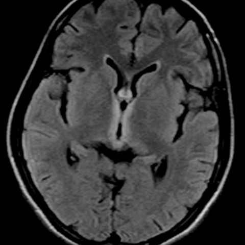 Non-alcoholic Wernicke’s encephalopathy- Role of MRI in diagnosis and ...