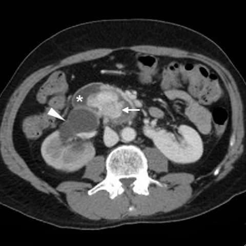 Renal carcinoma in horseshoe kidney with endoluminal duodenal invasion ...