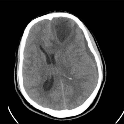 Brain abscess in a drug abuser with history of cocaine sniffing | Eurorad